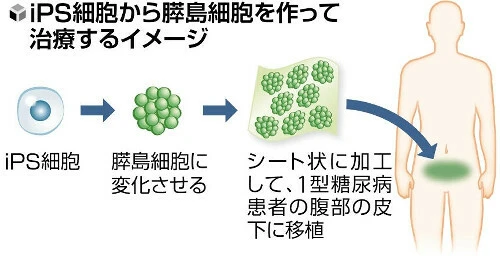 京都大学医院将iPS细胞制成的胰岛细胞移植到1型糖尿病患者体内无需胰岛素